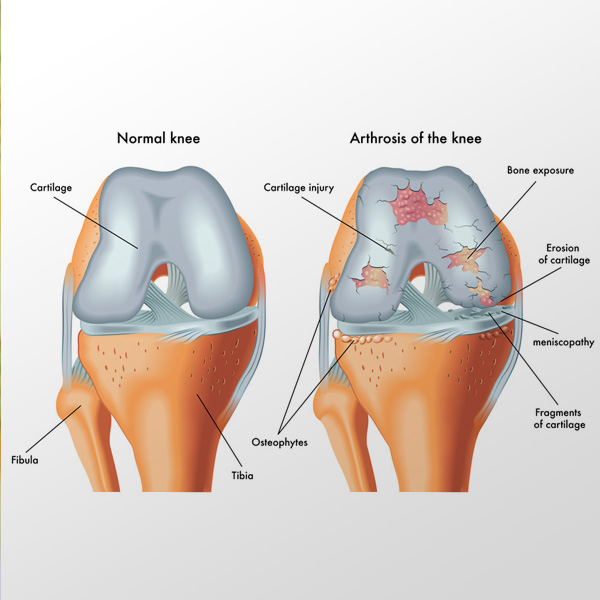 grindel unfallchirugie arthrose2