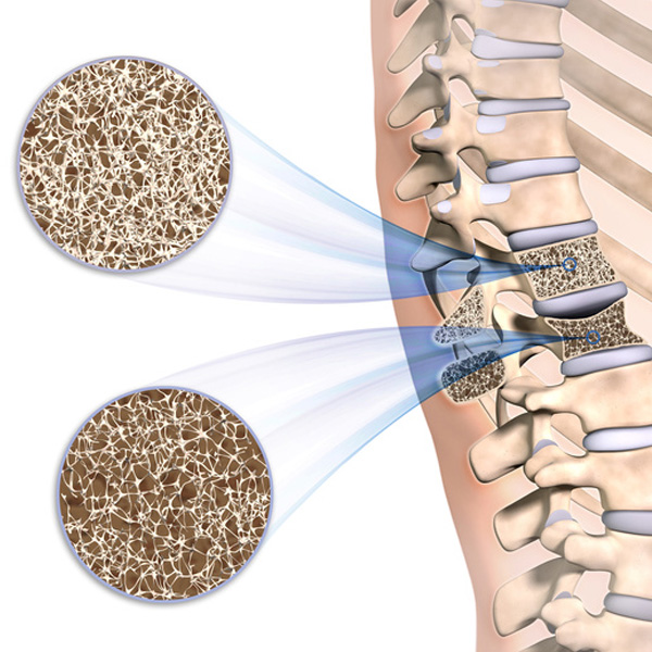 grindel unfallchirugie osteoporose2